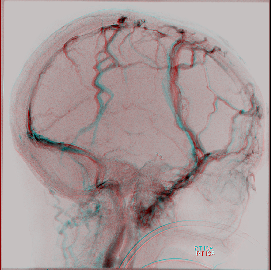 Diploic Veins